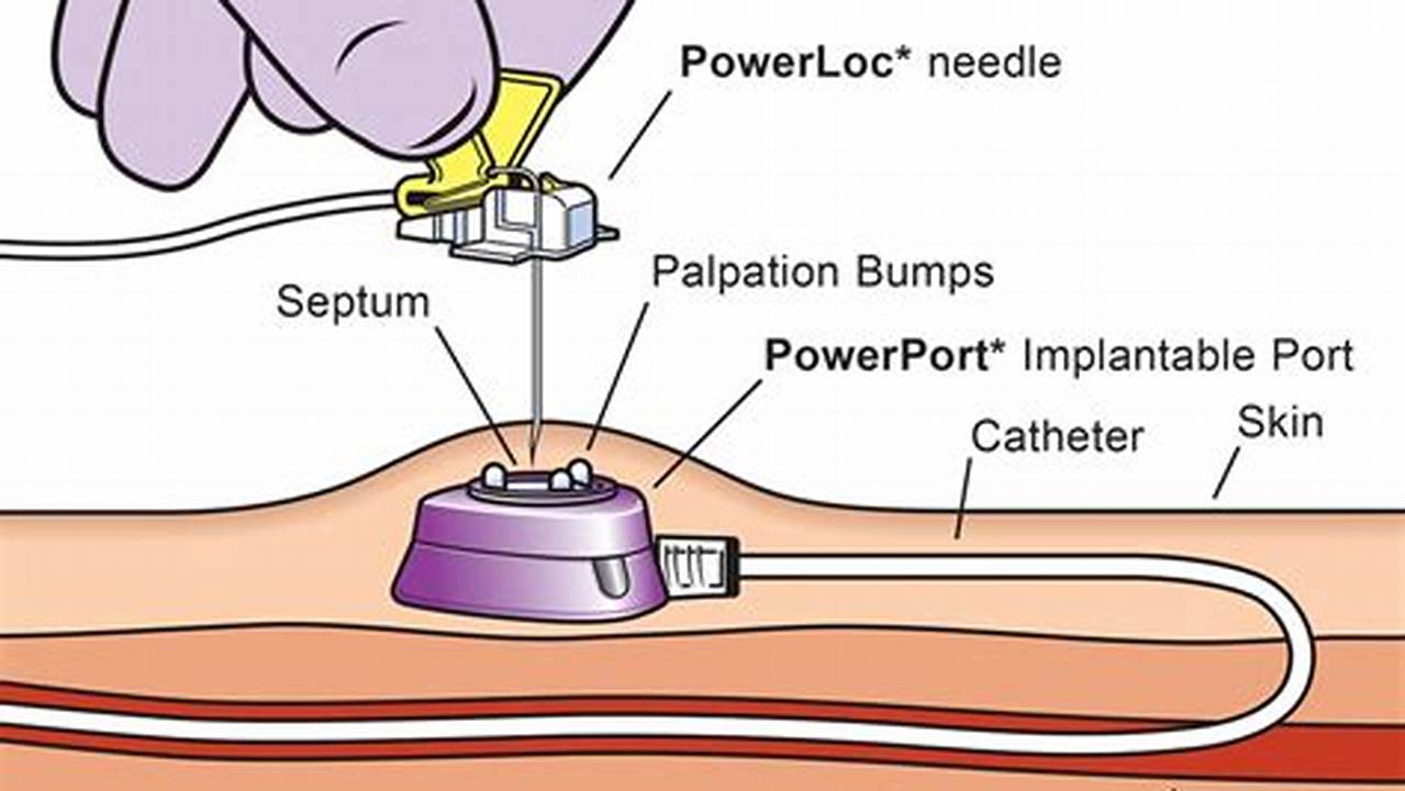An Easy-to-Follow Guide on Accessing Your Port-A-Cath Safely and Effectively