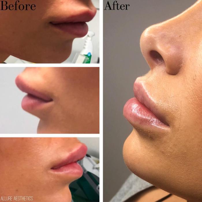 How long does it take for filler to dissolve