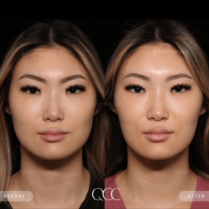 How long does it take for masseter botox to work