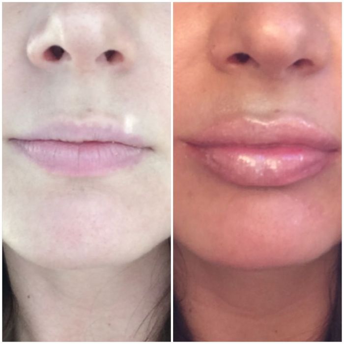 Lip injections getting know things should before How old do you have to get lip injections