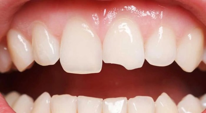 How one can Pull a Damaged Tooth A Information