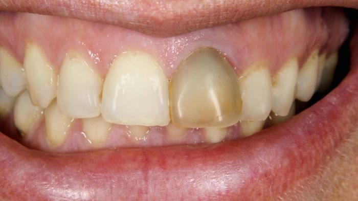 Teeth stains remove can How to remove black stains on baby teeth