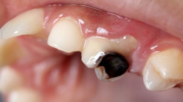 Teeth stains denti dentisti vignato figlio tuo macchie nere stain vicenza How to remove black stains on baby teeth