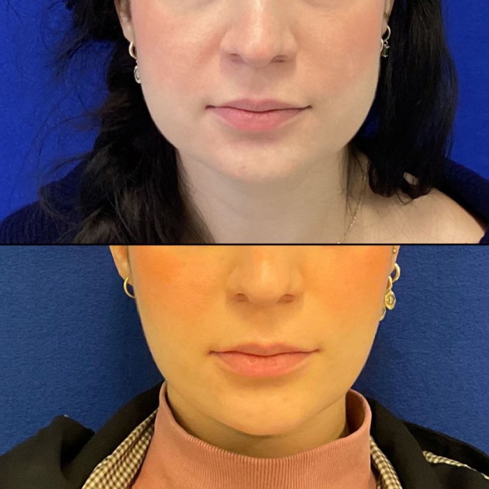 How long for masseter botox to work