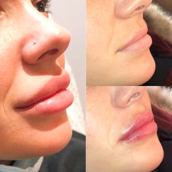 How long does it take for filler to dissolve