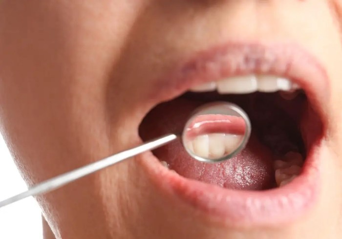 How to prevent dentist from knowing you smoke