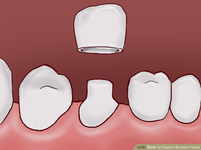 Teeth dentists loose How to pull a broken tooth