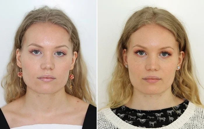 How long does it take for masseter botox to work