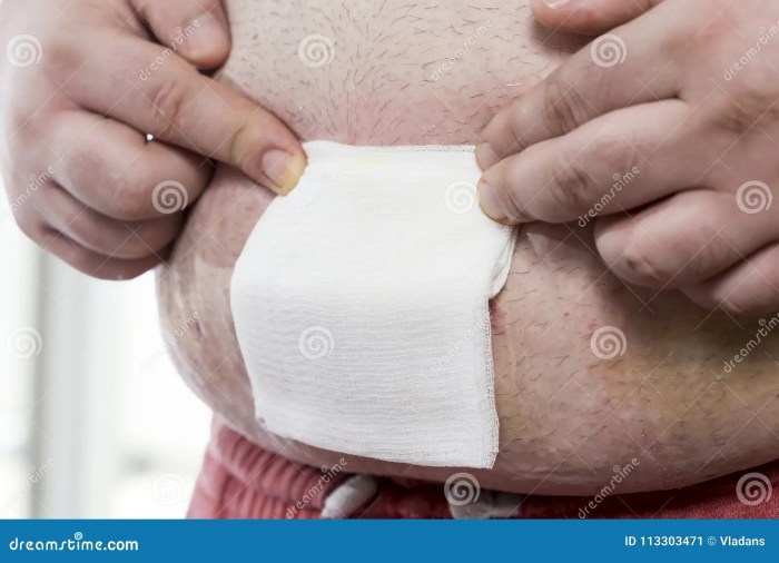 How to remove gauze stuck on wound