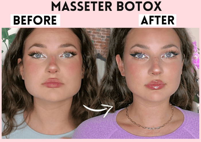 How long for masseter botox to work