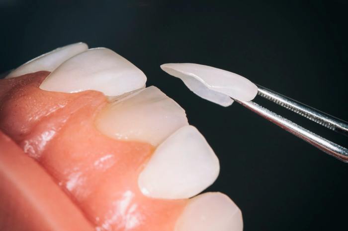 How long does it take to get used to dentures